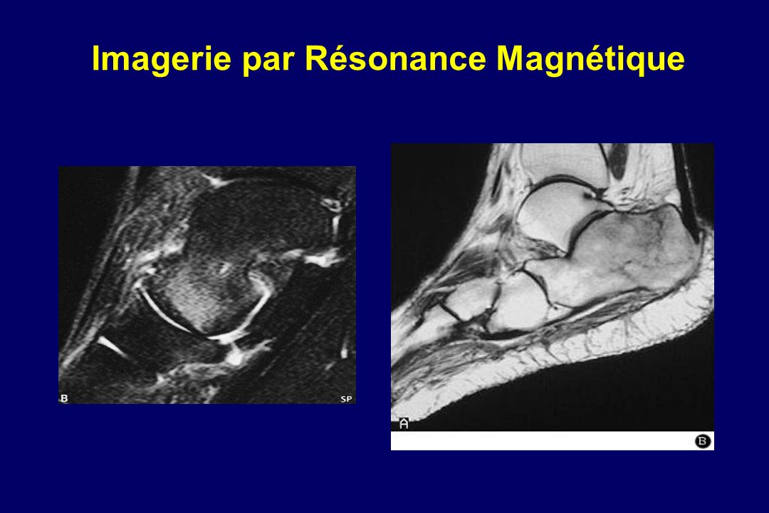 ALGODYSTROPHIE DU PIED ppt video online t l charger